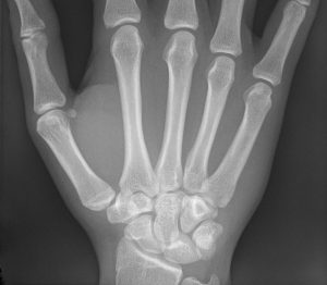 HandXRay-300x262